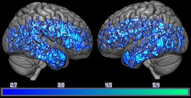 Image shows serotonin levels in brain scans.