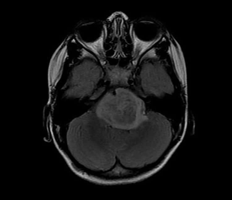 This image shows a brain scan of a glioma brain tumor.