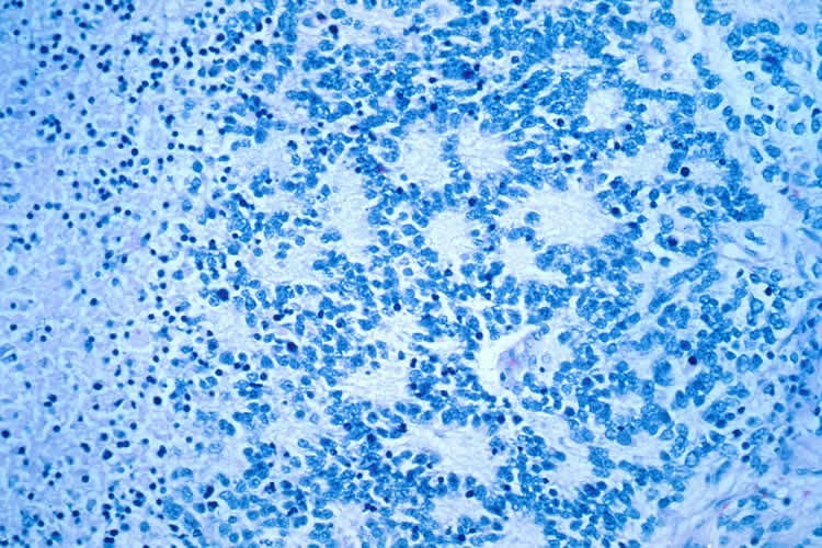 Image shows neuroblastoma cancer cells.