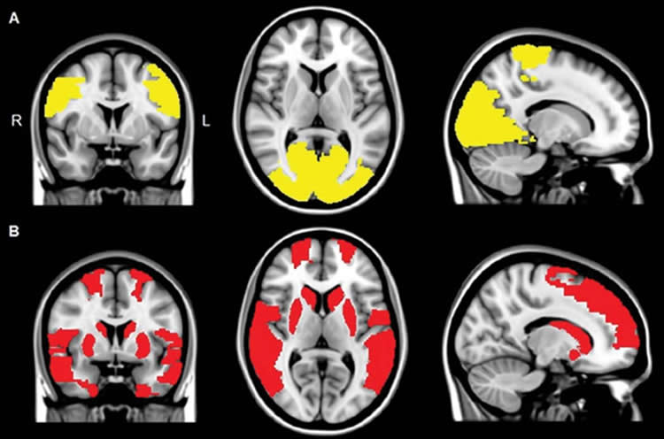Image shows brain scans