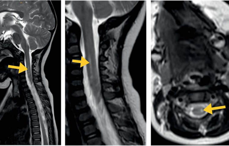 Image shows spinal MRI scans.