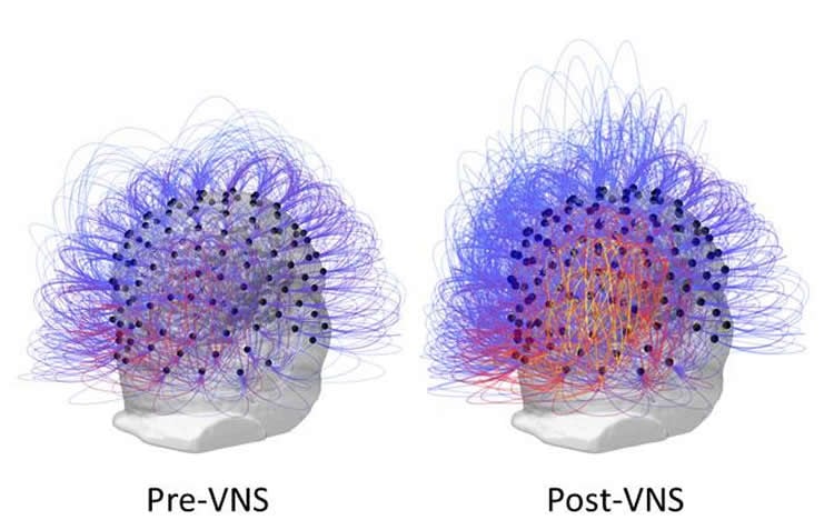 Image shows the increased connectivity following VNS.