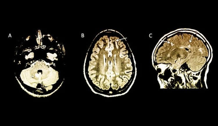 Image shows brain scans from kids with MS.