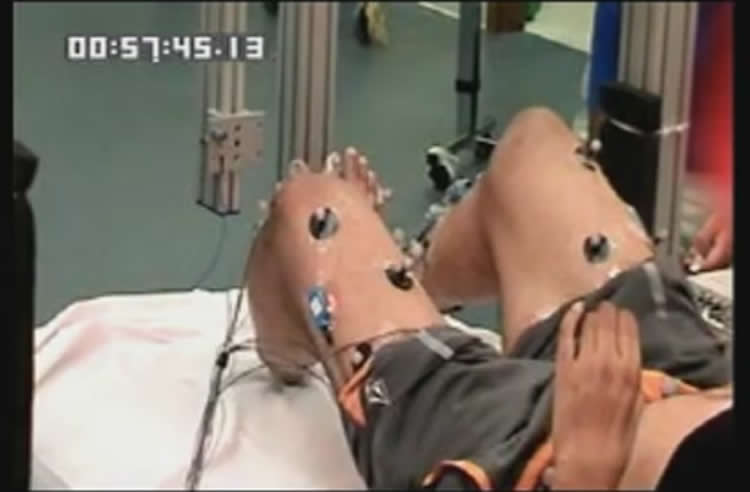 Image shows the patient's legs with stimulators attached.