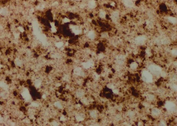 Image shows a brain of a CJD patient.