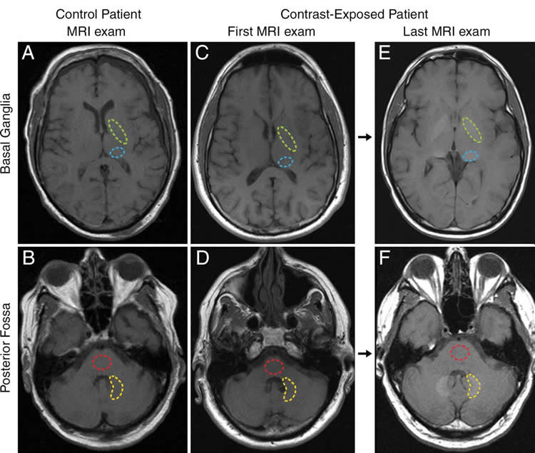 Image shows brain scans.