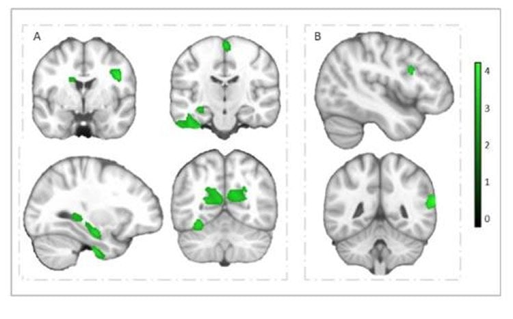 brain scans are shown