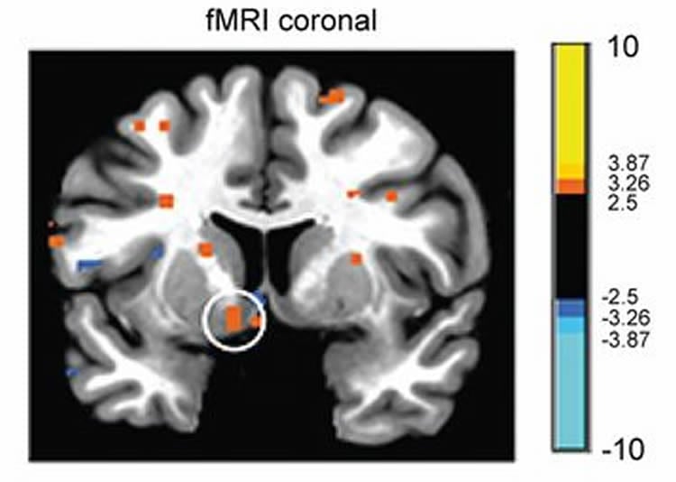 brain scan with the NAC higlighted