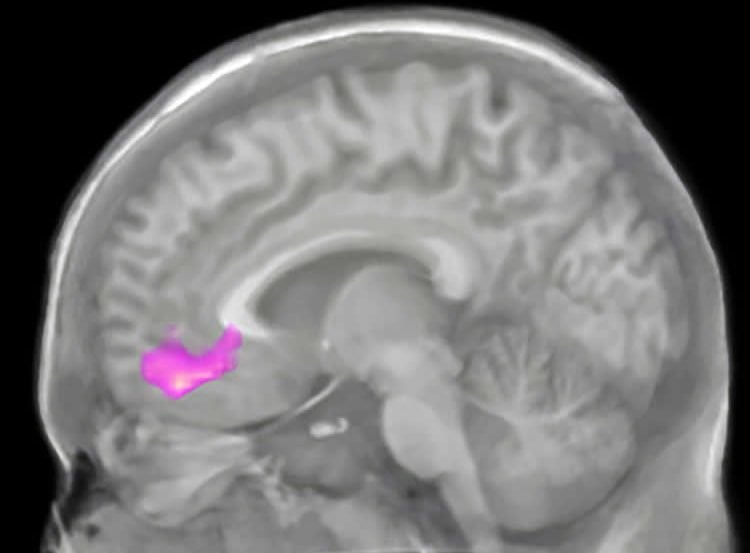 Image shows a brain scan with the VMPFC highlighted.