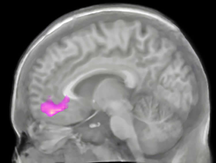 Image shows a brain scan with the VMPFC highlighted.