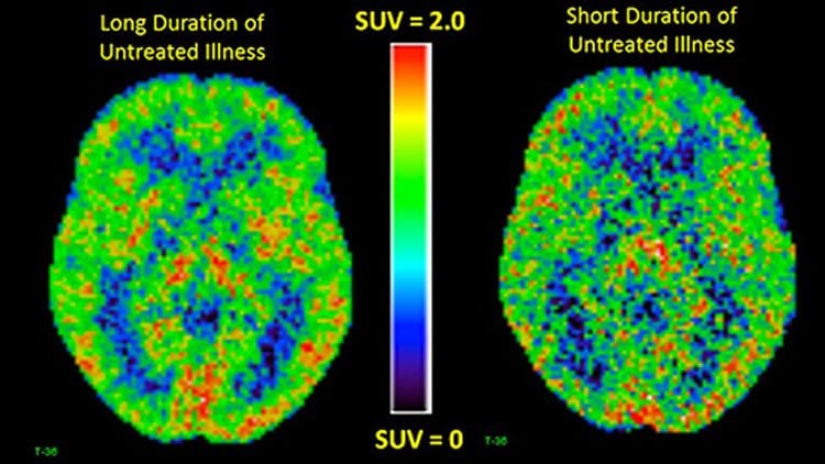 pet brain scans