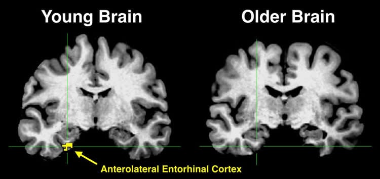Image shows brain scans with the anterolateral entorhinal cortex highlighted in yellow.
