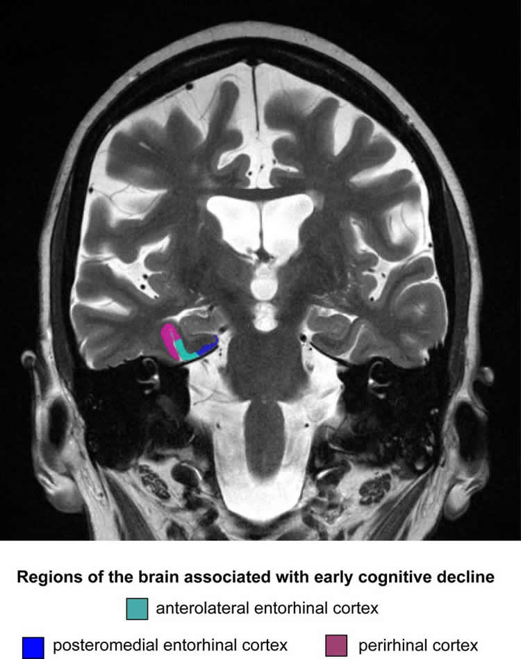 Entorhinal Cortex