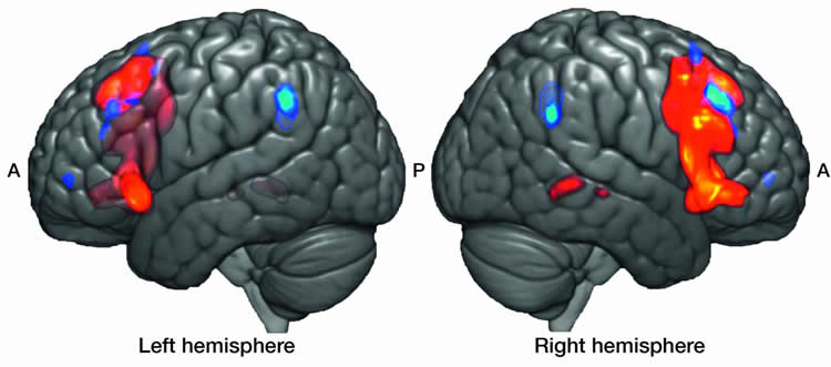 brain scans of broca's area