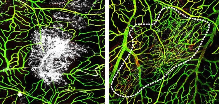 meninges