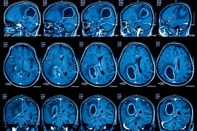 MRI scans from a person with glioblastoma brain cancer