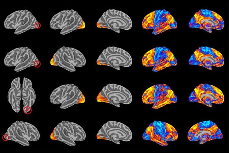 brain scans