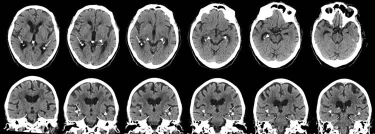 brain scans of a man with severe brain calcifications