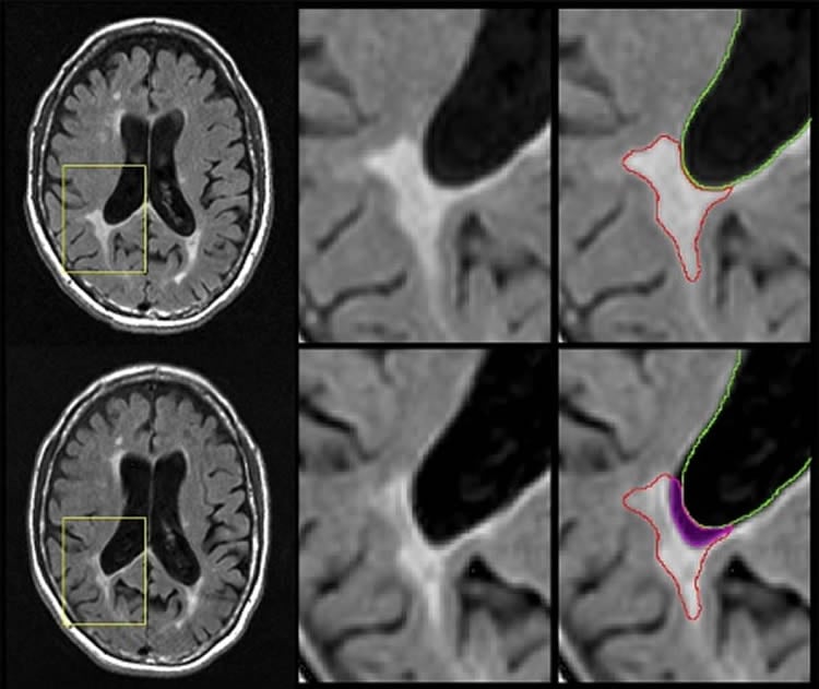 mri scans