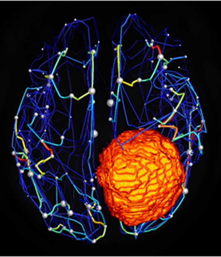 the brain tumor in the virtual brain simulation