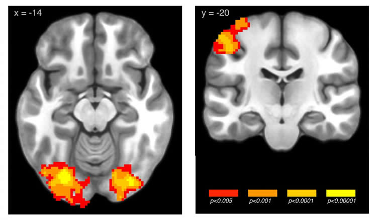 brain scans