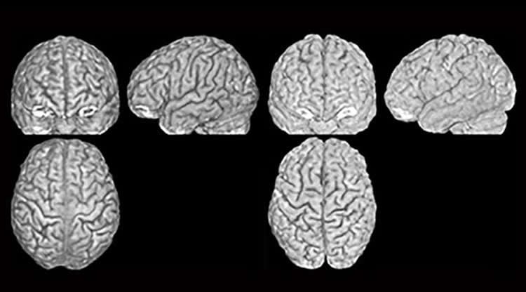 brain scans