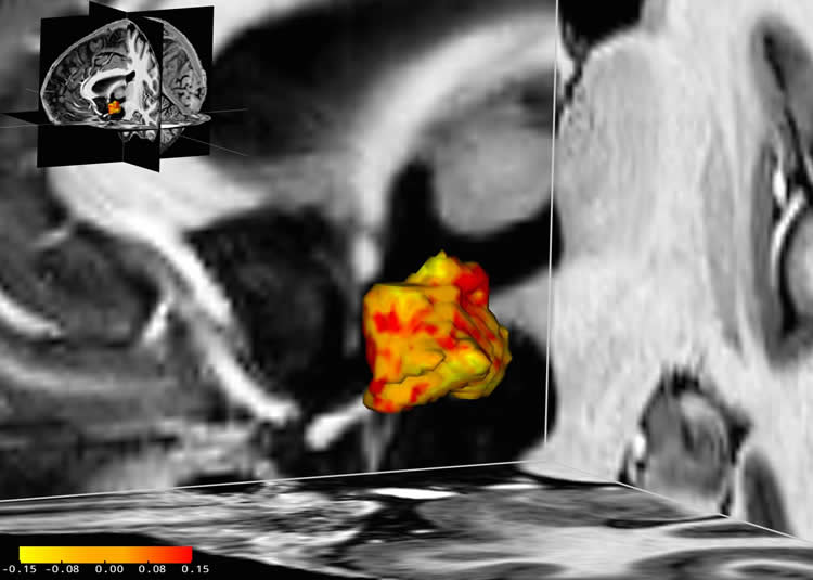 a brain scan showing the hypothalamus
