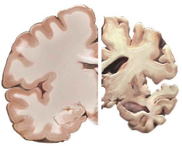 an alzheimer's brain slice