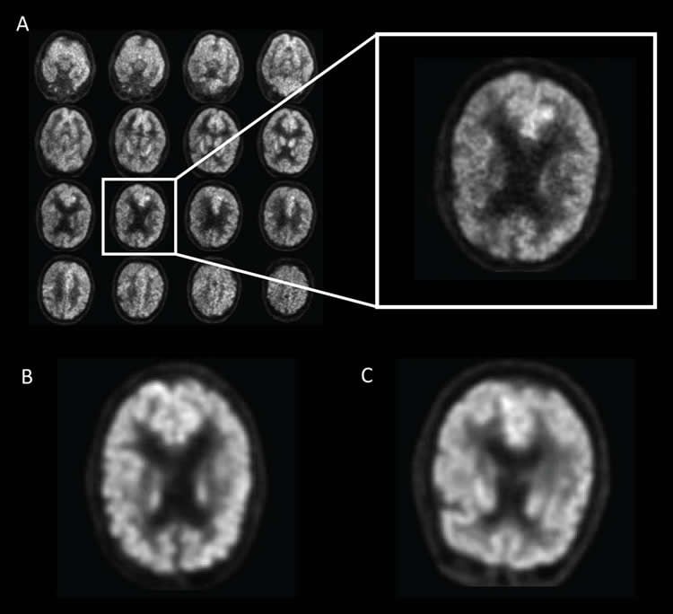 brain scans of Alzheimer's patients