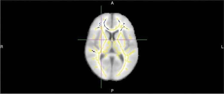 brain scan