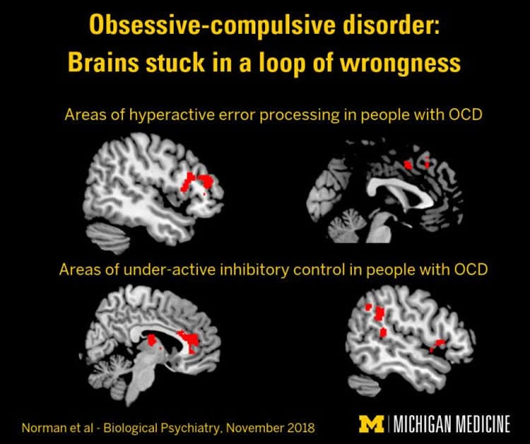 brain scans of ocd patients