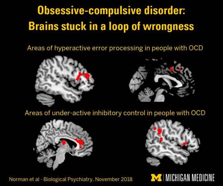 How To Stop Intrusive Thoughts Ocd