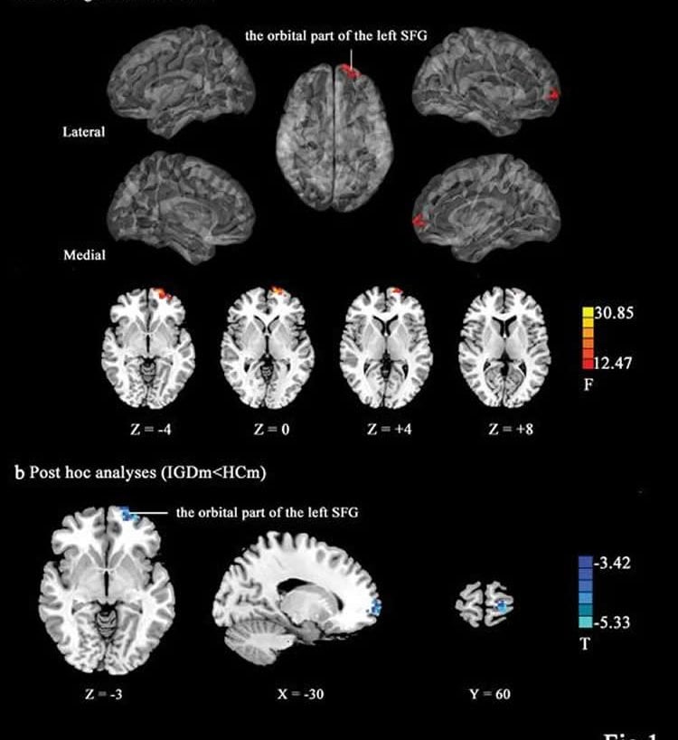 brain scans