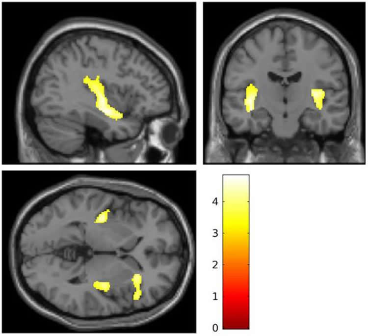 brain scans