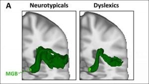 Diving Deeper Into Developmental Dyslexia - Neuroscience News