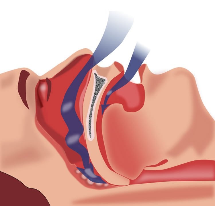 sleep apnea diagram