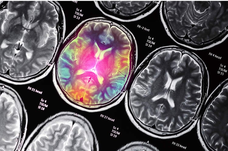 colored brain scan