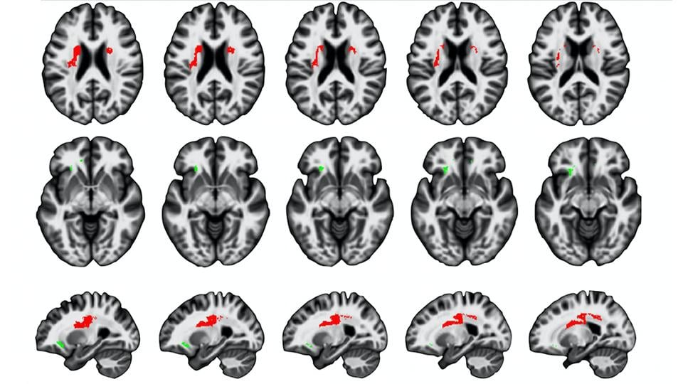 Brain images are shown with some areas highlighted.