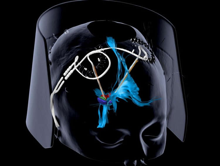 image is a diagram of the dbs implants in the brain