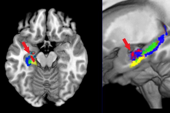 A brain scan is shown with areas colored in. The caption describes well.