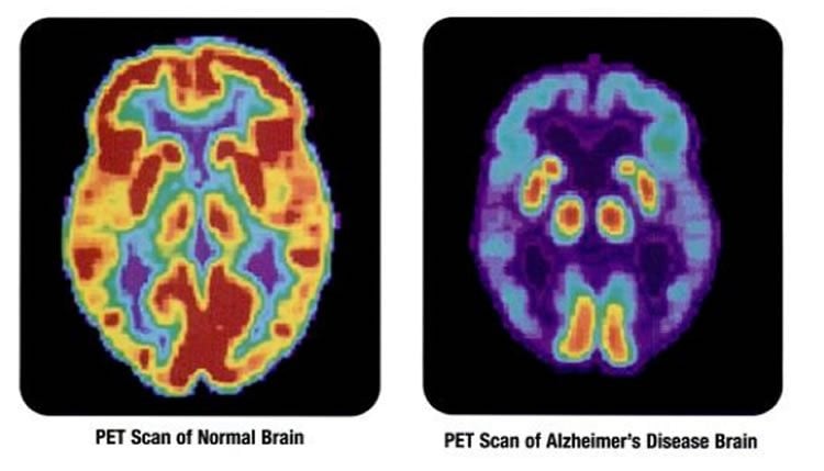 PET brain scan of an alzheimer's patient