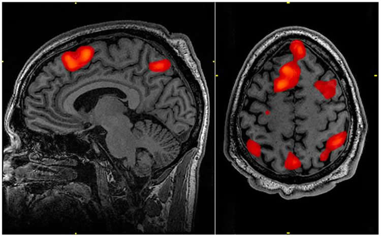 a brain scan highlighting the parietal cortex