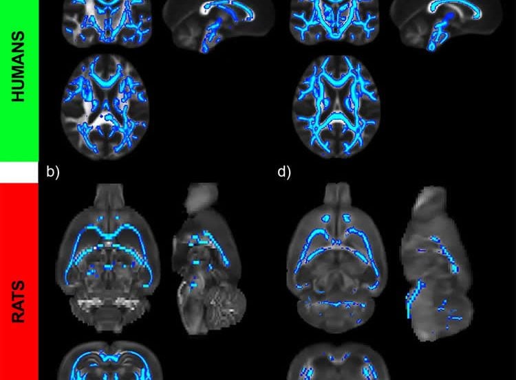 This image shows brain scans of the continued damage alcohol does to the brain