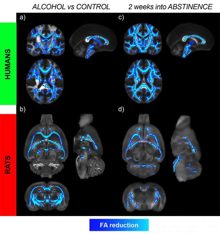 This image shows brain scans of the continued damage alcohol does to the brain