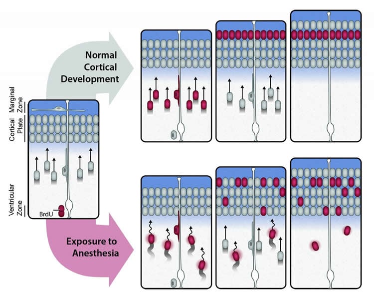 Image is a diagram showing how anesthesia disrupts neurodevelopment