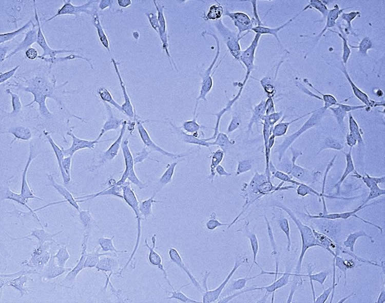 This shows glioblastoma stem cells