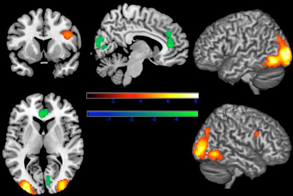 This shows brain scans with the lack of anterior cingulate cortex activity