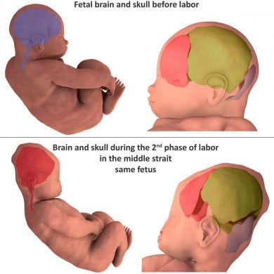Image shows how the head shape changes during delivery