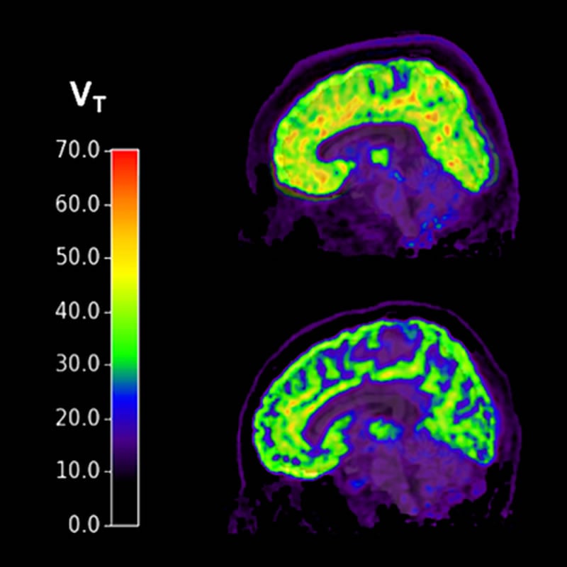 This shows brain scans of people with PTSD