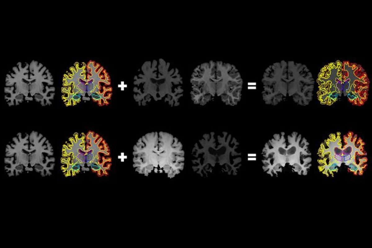 This shows MRI brain scans
